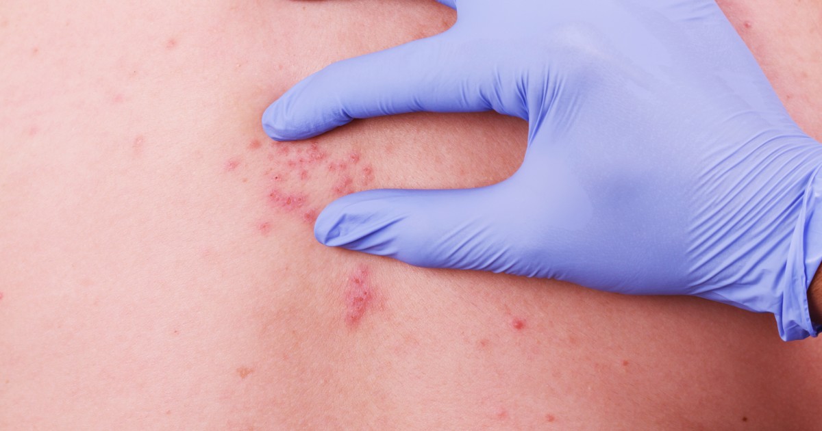 10 Symptoms of Shingles – Healthversed