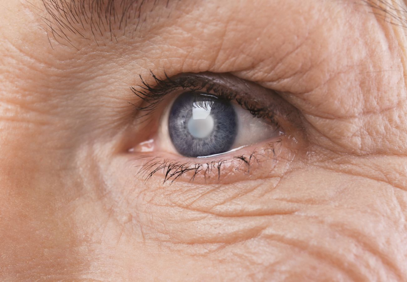 Cataracts Diagnosis And Treatment When Is It Time To Consider Surgery Healthversed